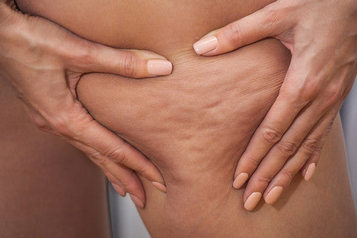 How and why Cellulite forms - and what to do about it.